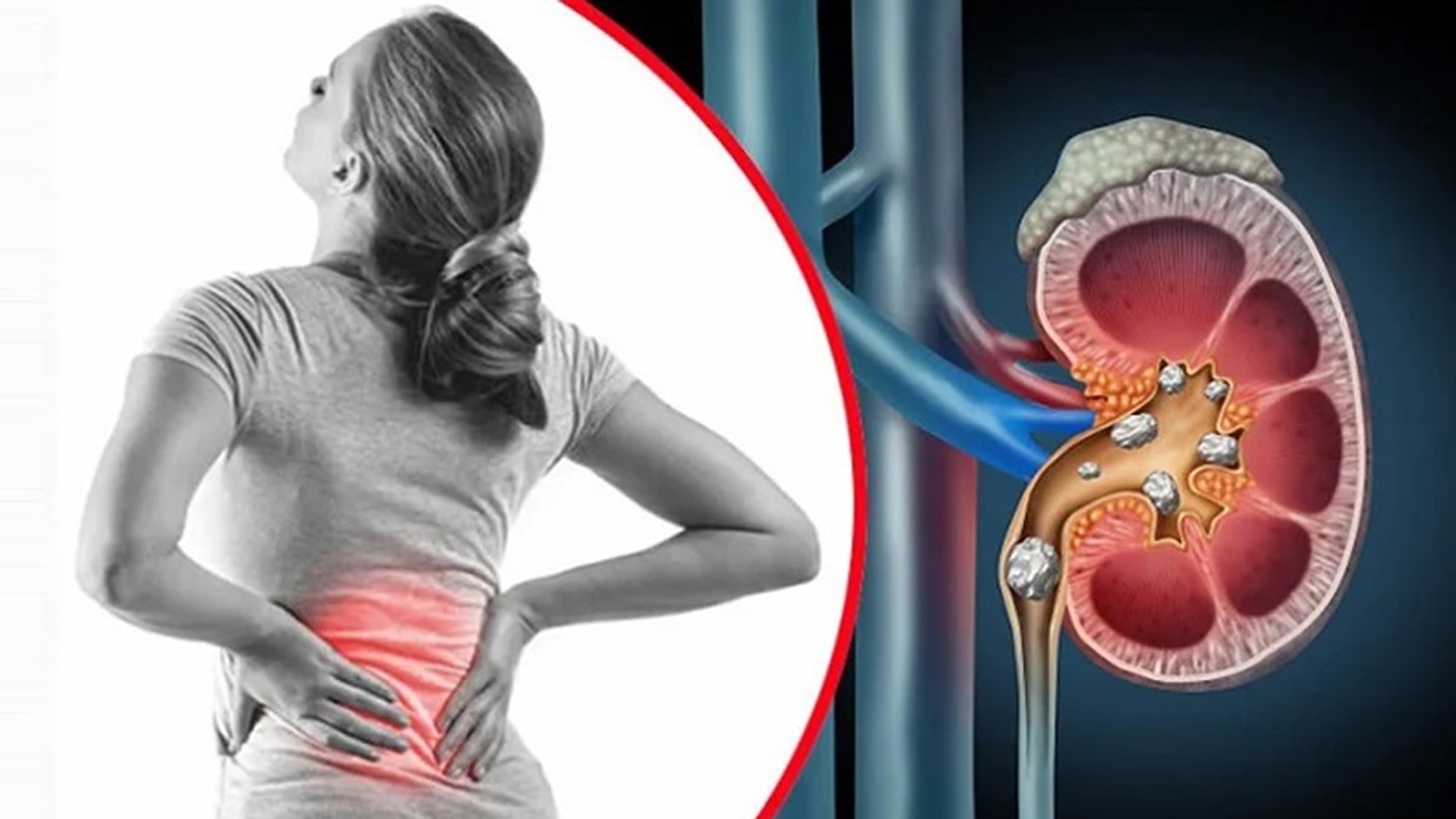How to prevent kidney stones during winter