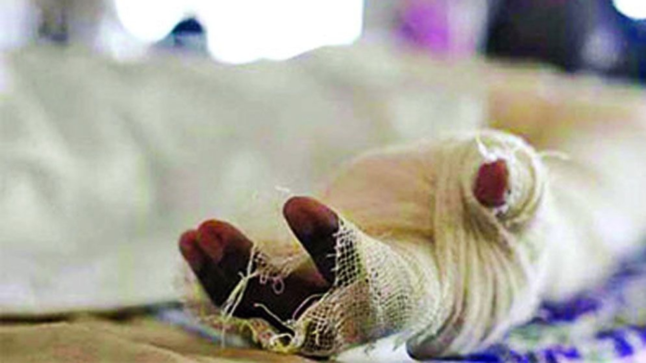 Why burn patients need so much blood
