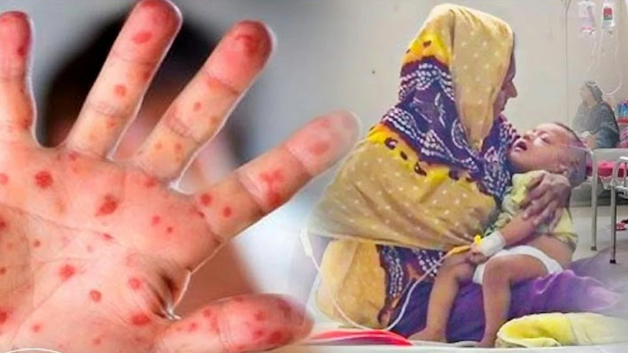 ‘হামে শিশু মৃত্যু, দায় এড়ানোর সুযোগ নেই বিএনপির
