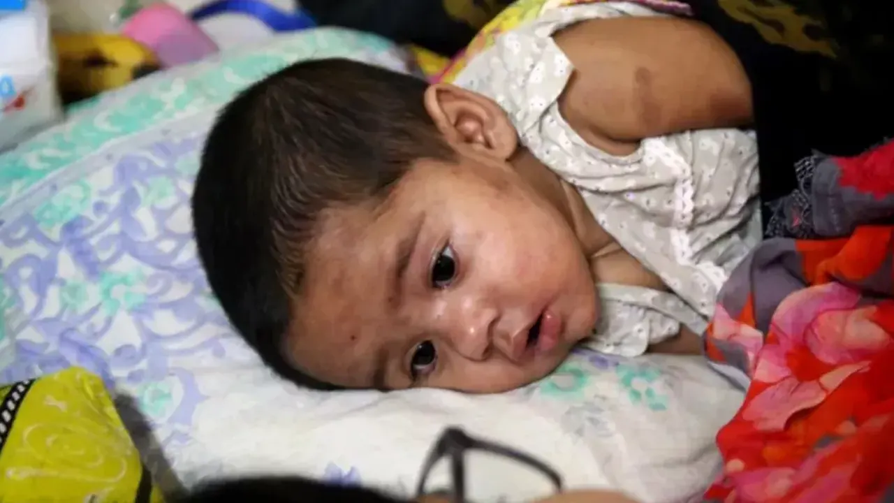 হাম উপসর্গ নিয়ে ২৪ ঘণ্টায় আরও ৩ শিশুর মৃত্যু