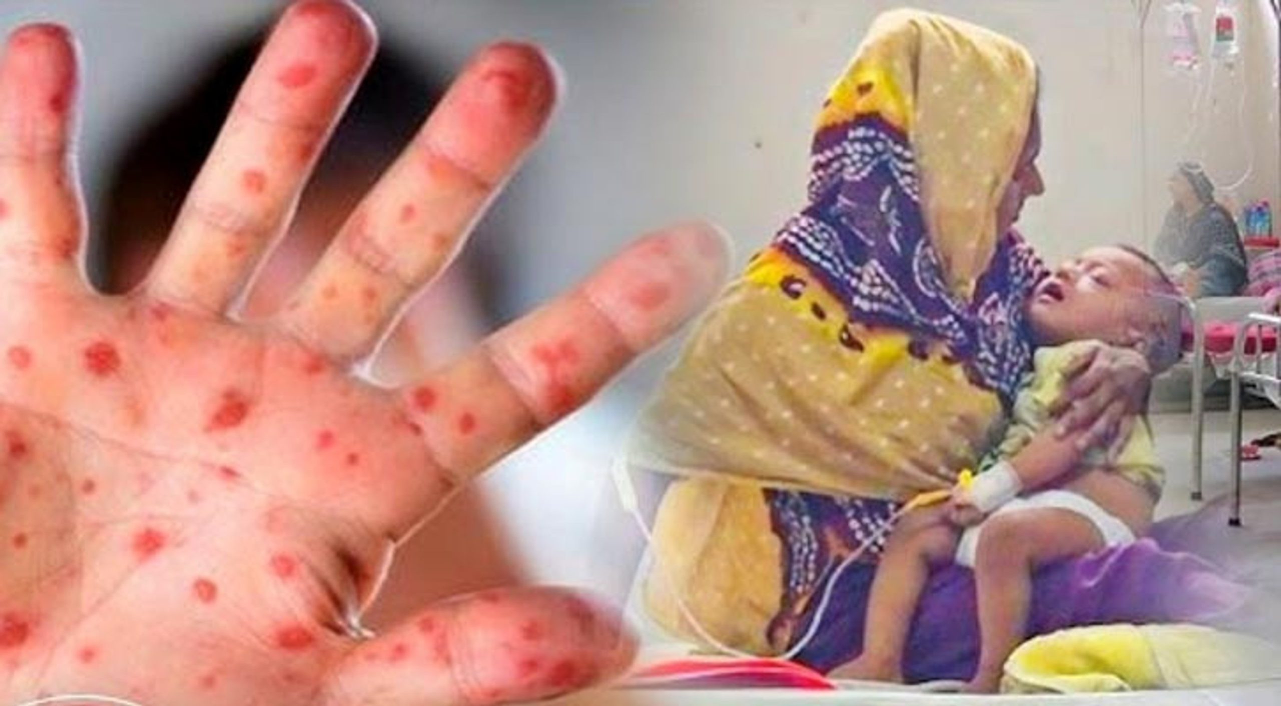 হাম উপসর্গে আরো ৩ শিশুর মৃত্যু