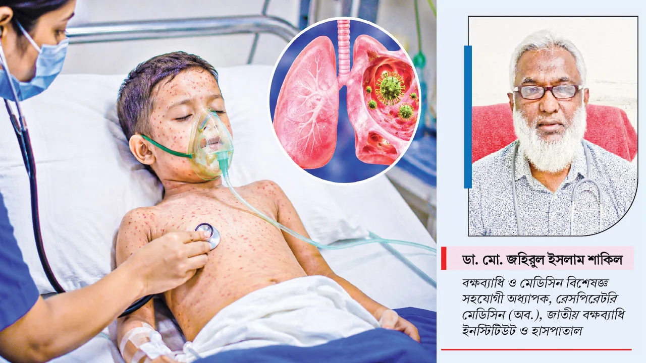 হামের ইনফেকশনে নিউমোনিয়া হতে পারে