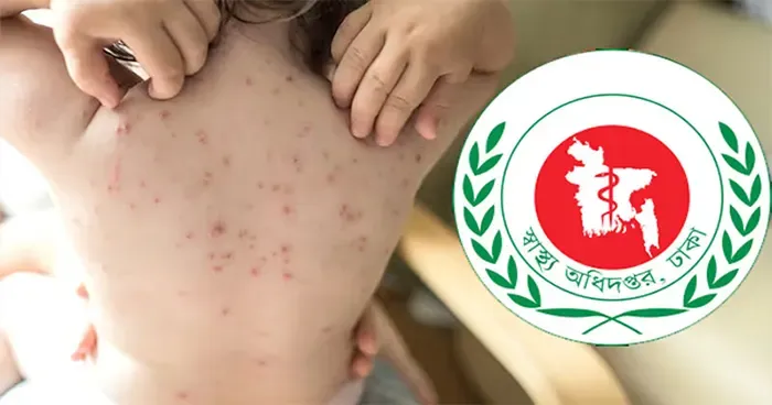 হাম উপসর্গে আরও ৪ শিশুর মৃত্যু