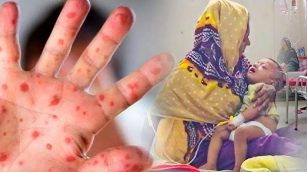 হাম উপসর্গে এক দিনে ৭ জনের মৃত্যু