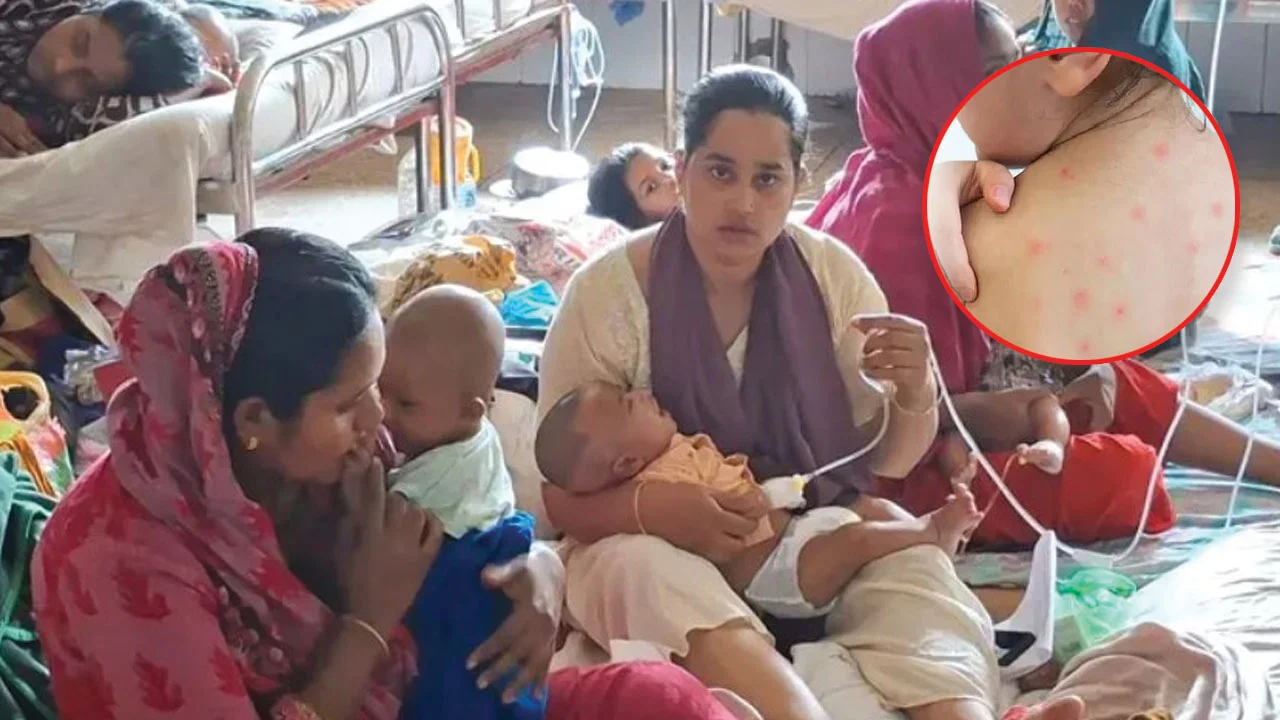 ৫ মাসে হাম ও হামের উপসর্গে প্রায় ১ হাজার শিশুর মৃত্যু